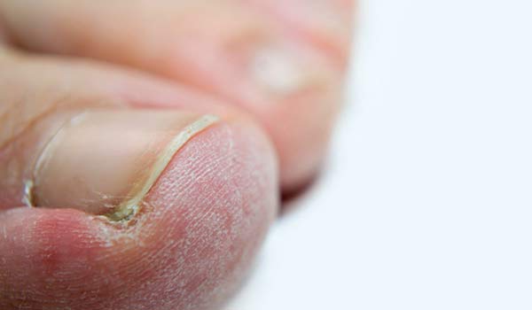 how to know if toenail fungus is dying