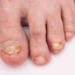 what kills toenail fungus instantly
