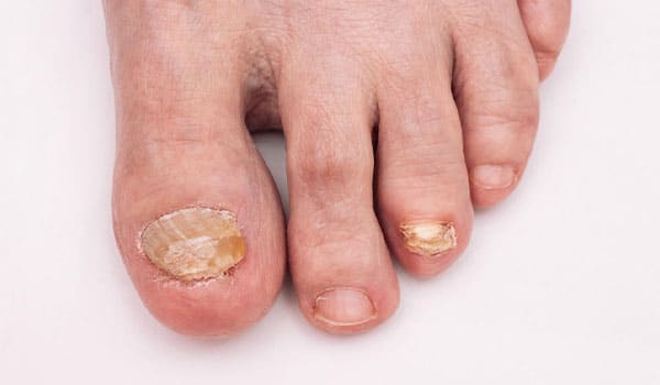 what kills toenail fungus instantly