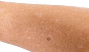 vitamin deficiency small white spots on skin